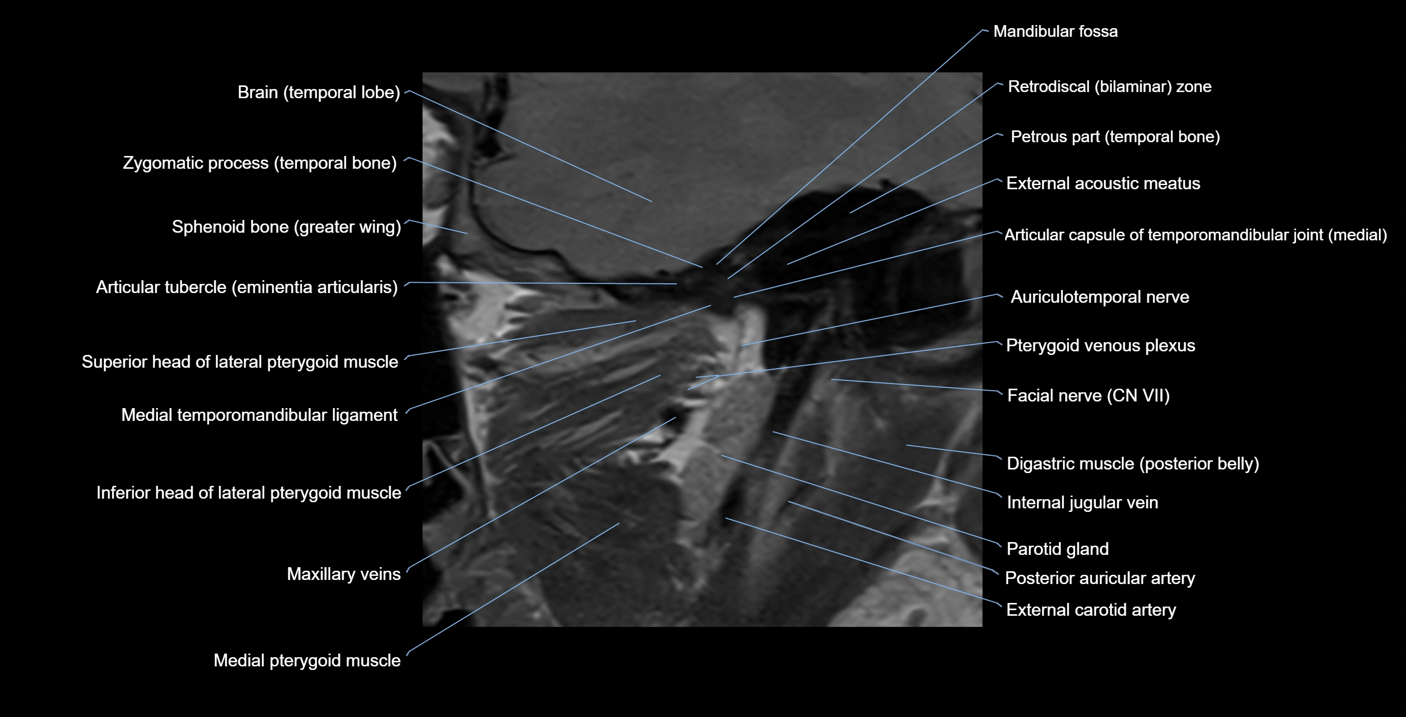 MRI TMJ sagittalclosed  mouth cross sectional 3T anatomy -img-00001-00013.webp
